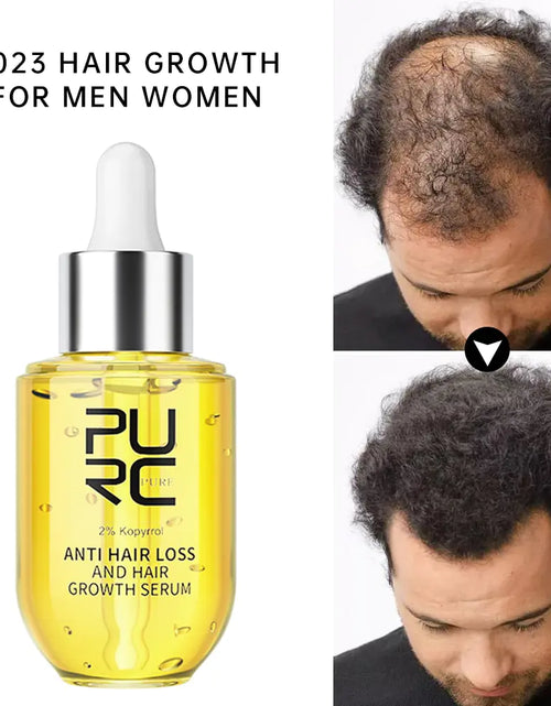 Load image into Gallery viewer, Fast Hair Growth Serum PURC Ginger Oil for Men &amp; Women
